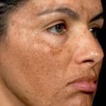 melasma treatment