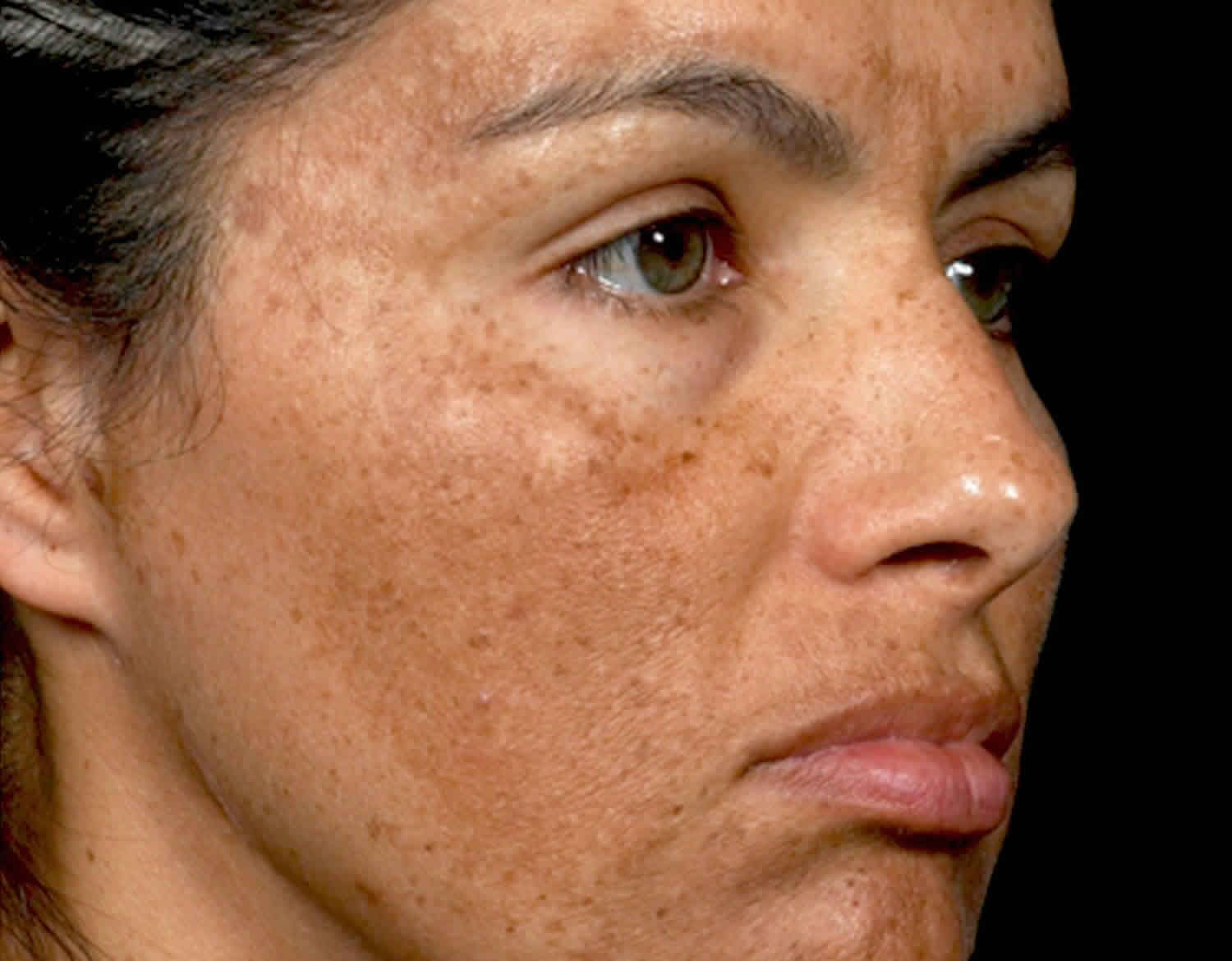melasma treatment