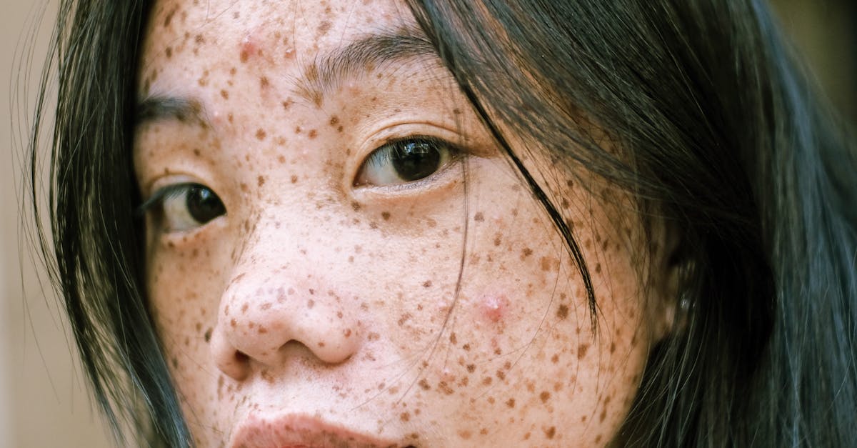 Remove Pimple Marks